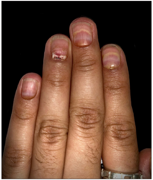 Haemorrhagic onycholysis with multiple pus-filled lakes under the proximal nail plate.